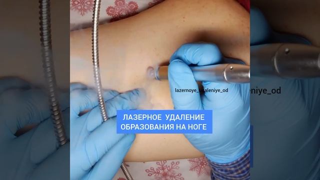 Лазерное удаление образования - липомы  на ноге
