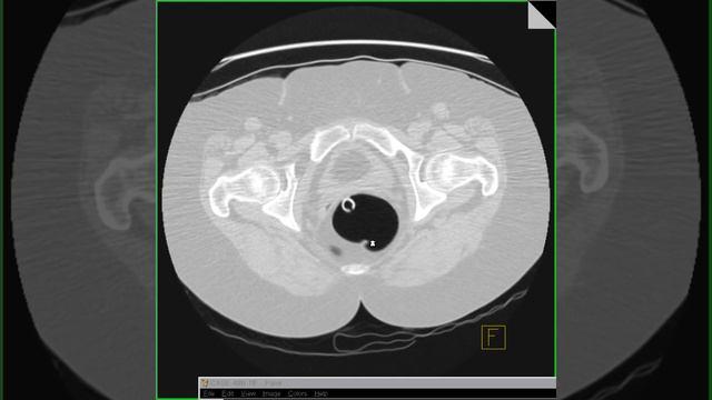 Virtual colonoscopy in 2D and small rectal polyp