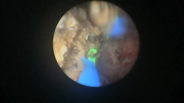 Mini PCNL Horseshoe kidney/ миниперкутанная нефролитотрипсия на подковообразной почке. Случай #32.