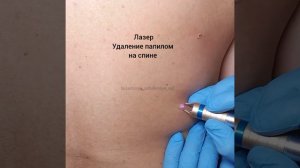 Лазерное удаление папиллом на спине