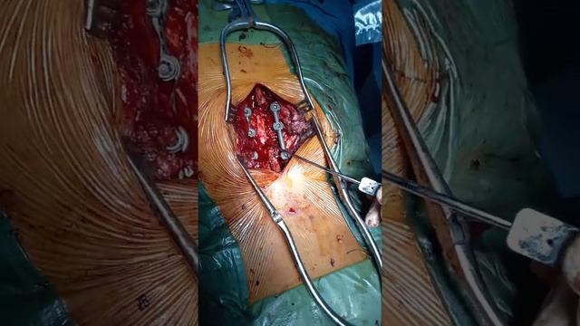 cauda equina syndrome D12 fracture Decompression and stabilization смотреть онлайн