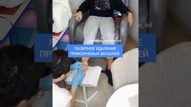 Удаление лазером прикорневых мозолей