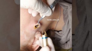 Удаление новообразования на лице лазерным методом