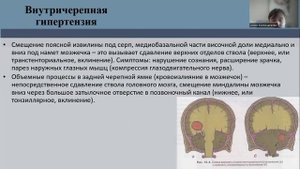 Менингеальный и гипертензионный синдромы, гидроцефалия