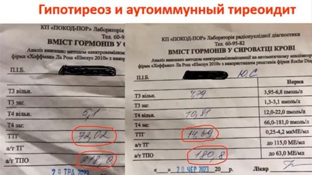 Аутоиммунный тиреоидит, гипотиреоз, Сибирское Здоровье