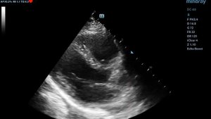Работа митрального клапана стоя - MIndray DC-80