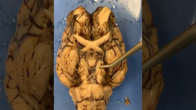 Brain Dissection - Cranial Nerves