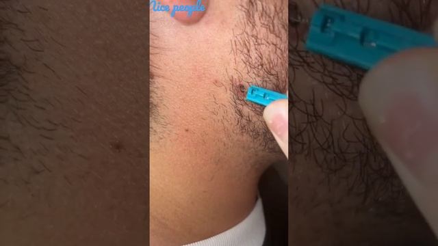 ازالة شعرة طويلة من تحت الجلد 152 смотреть онлайн