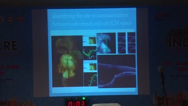 AIOC2019 IC340 Topic Management of a retinal detachment with a choroidal coloboma Dr Gopal смотреть онлайн