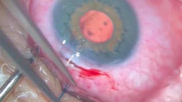Artificial Iris+IOL Complex Implantation. Имплантация комплекса «Искусственна радужка+ИОЛ»