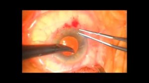 устранение дислокации ИОЛ  Корнеосклеральная фиксация   SD 480p