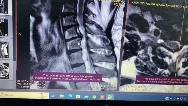 Ужас в шее. Грыжи, остеофиты! Лечение или операция? смотреть онлайн