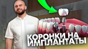 Какие коронки устанавливаются на имплантаты?