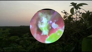 Ear Wax Removal Eps#258 || чистка ушной серы #258