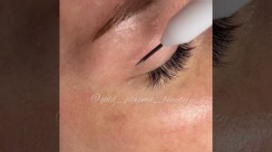 Безоперационная блефаропластика