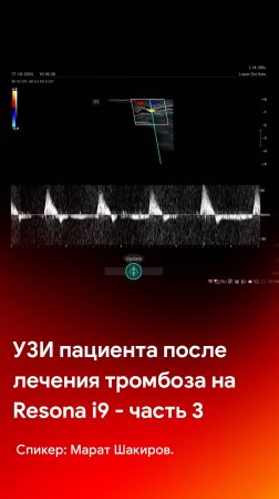 УЗИ после лечения тромбоза вен нижних конечностей. Часть 3