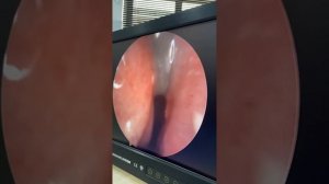 Бурун полиплари давоси.