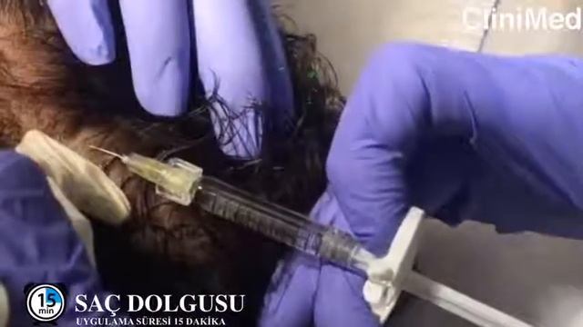 Clinimed Nisantasi - Hair Mesotherapy and PRP (Platelet Rich Plasma) Application