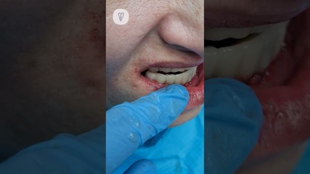 На первом этапе - 10 имплантатов 2 синус лифтинга и временные зубы для пациента. Имплантация зубов.