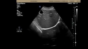 Гемангиома печени и гемангиома почки