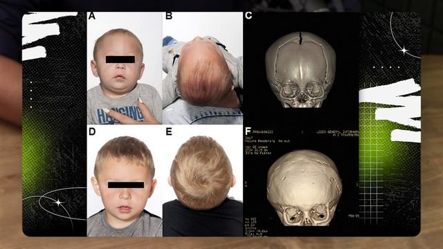Краниосиностоз: как лечить, когда лечить и нужно ли лечить?