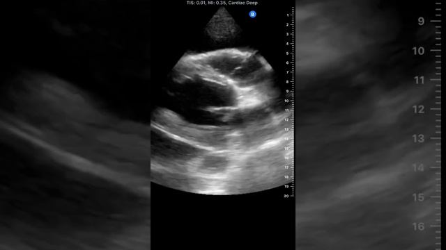 Pericardial effusion and left pleural effusion