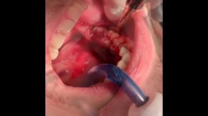 Удаление зубов мудрости. 8 კბილის ექსტრაქცია.