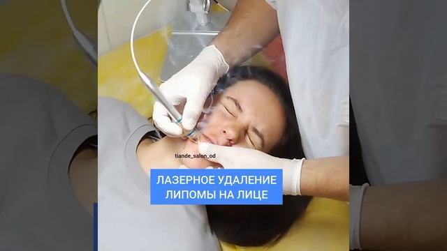 Лазерное удаление образований