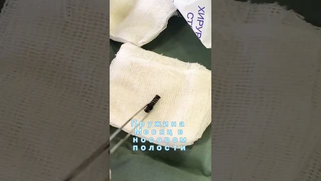 Ребёнку 1.8 инородное тела в носовой полости (ПРУЖИНА ) смотреть онлайн