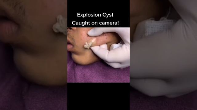 Cystic Acne Removal & Inflammatory Acne смотреть онлайн