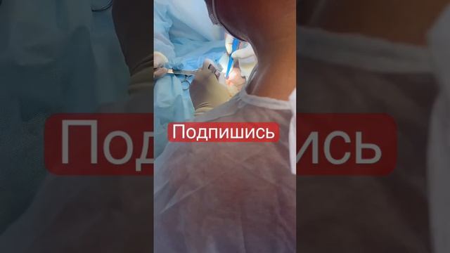 Пластика шеи, платизма пластика