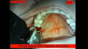 Экстракция 16 зуба.