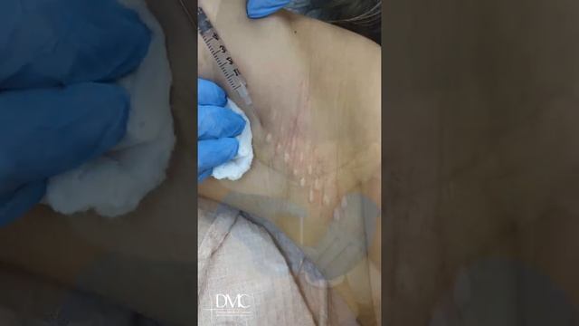 Лечение гипергидроза смотреть онлайн