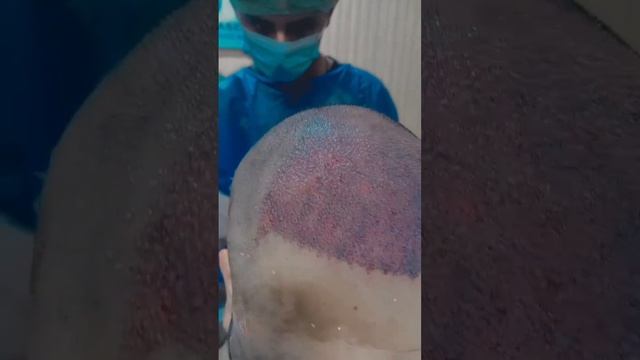 Hair Transplant #love #song #lovesong #newsong #hairstyle #fuehairtransplant #realhairtransplant