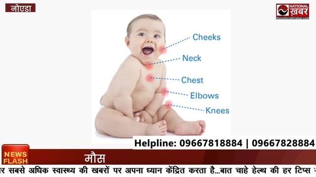 Atopic Dermatitis कय ह ? जनए लकषण और इलज ! La Fameux Derma  National Khabar