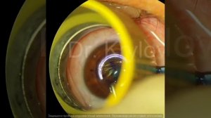 Кератоконус - серьёзное заболевание роговицы.