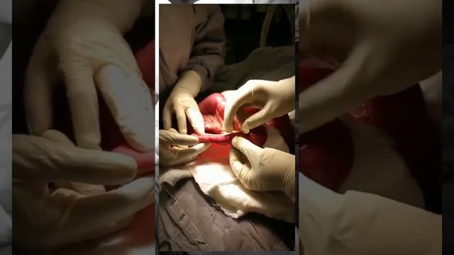 Small bowel obstruction 2ndary to ascaris lumbricoids смотреть онлайн