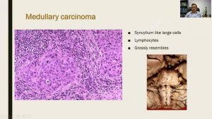 Carcinoma Breast Part 2 - FGT & Breast Pathology - R.A.T.S - Dr.G.Shivashekar - University question