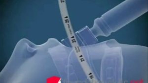 3D моделирование Интубация трахеи