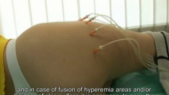 Multi-Injectory Low-Flow Ozone Technology for Cosmetic Purposes смотреть онлайн