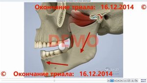 3 Биламинарная зона, компрессия, сточенные жевательные зубы
