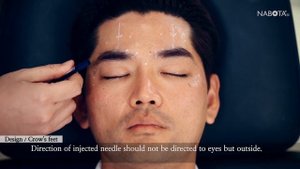 Kỹ thuật tiêm Nabota Botox 100dv