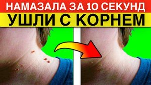ПАПИЛЛОМЫ УХОДЯТ С КОРНЕМ!!! #папилломы
