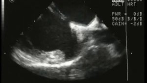 29. Дефект межпредсердной перегородки,чреспищеводное исследование (Atrial Septal Defect)