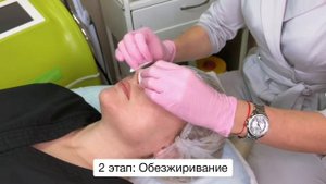 Азелаиновый пилинг
