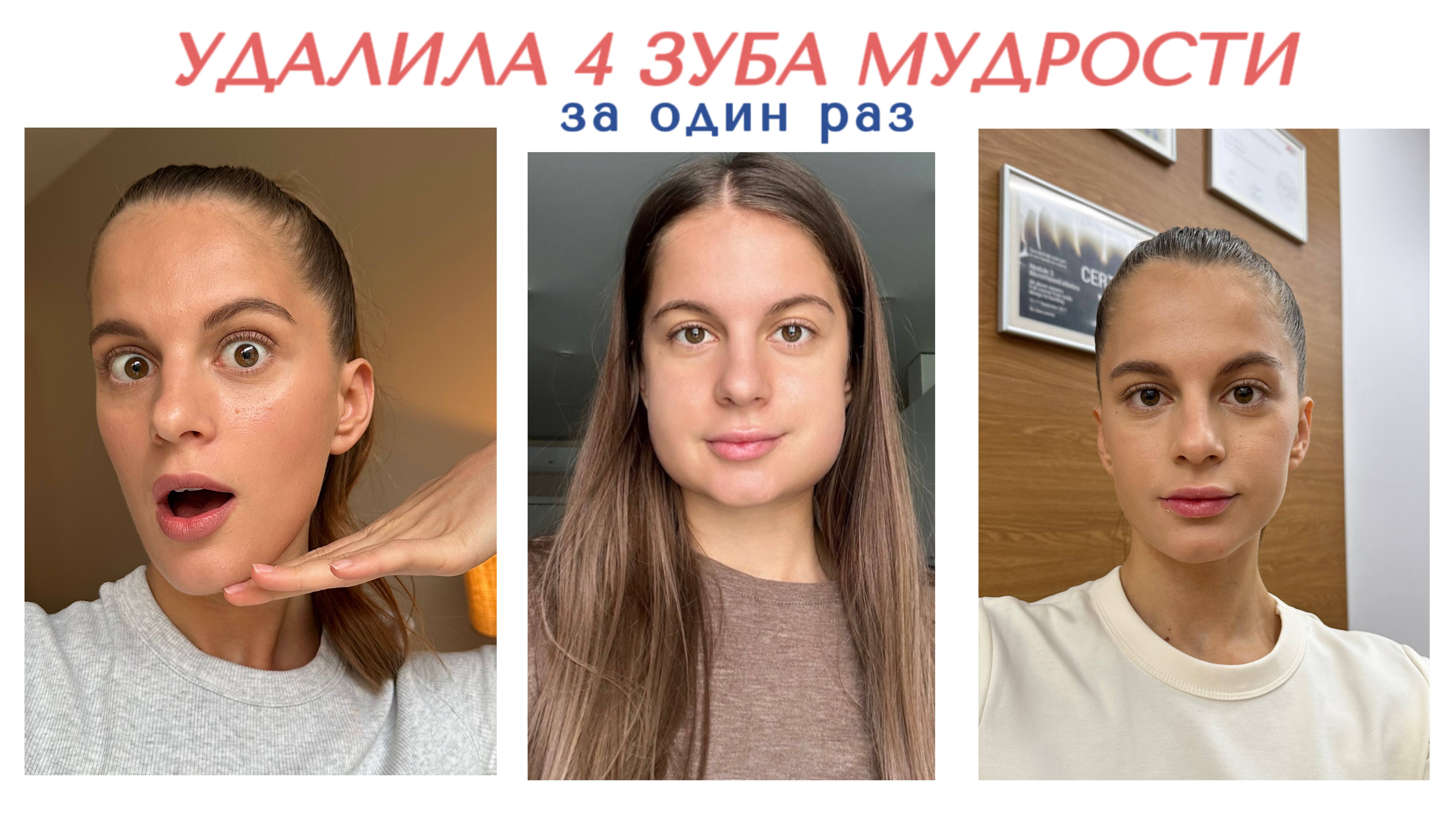 VLOG: удалила 4 зуба мудрости под седацией, моя реабилитация, сколько стоит?