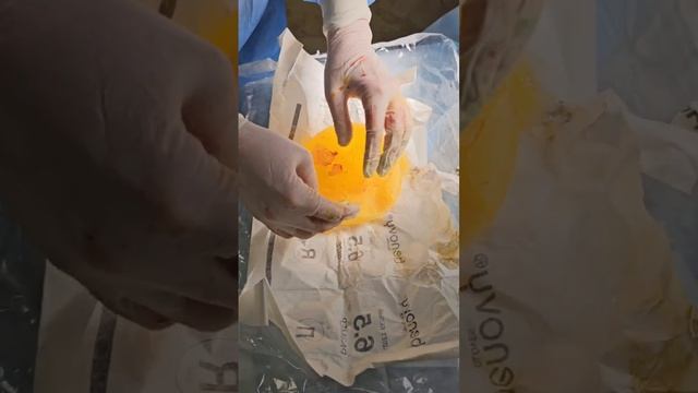 Извлеченный лопнувший имплант - почему мог произойти разрыв? смотреть онлайн