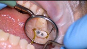 Tooth preparation for a zirconium crown. Препарирование зуба под коронку из циркония.