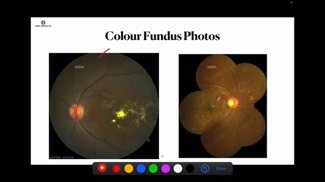 What do you know about Diabetic Macular Edema? - PART I смотреть онлайн