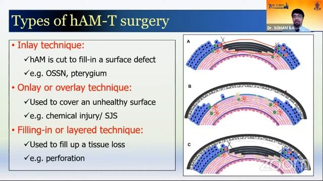 AIOC2021 - IC142 - Topic -Dr  SOHAM BASAK   1  Introduction 2  How to prepare human amniotic memb..